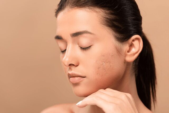 Treating Acne and Acne Scars