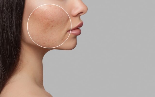 Microneedling and Acne Scar